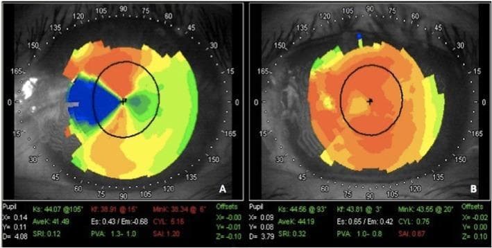 This diagnostic image set displays color-coded corneal topography maps of a left eye before (Image A) and after (Image B) surgical excision of a recurrent pterygium combined with phototherapeutic keratectomy (PTK). Image A shows a preoperative state with significant irregular astigmatism, characterized by a concentrated blue area in the nasal quadrant indicating steep corneal curvature and high refractive power contrast. Quantitative data in Image A notes a high cylinder value of 5.15 D and a surface asymmetry index (SAI) of 1.20. Image B displays the postoperative result two weeks later, showing a more uniform color distribution (primarily orange and yellow) across the central cornea, signifying a smoother surface and more regular curvature. Corresponding data in Image B reflects clinical improvement with the cylinder reduced to 0.75 D and SAI reduced to 0.67. This comparison illustrates the efficacy of PTK in regularizing the corneal surface and reducing cylinder following pterygium removal in ophthalmology patients.