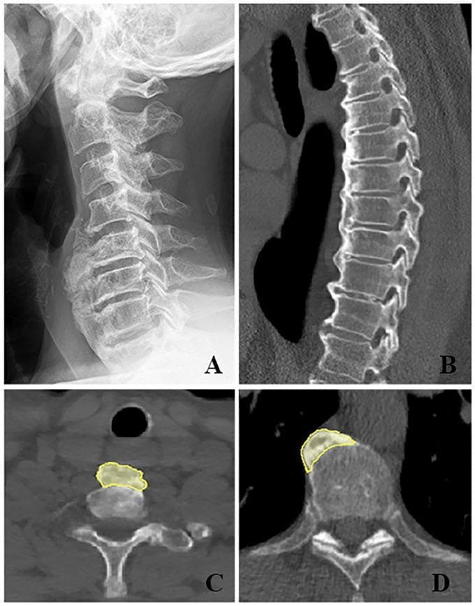 This composite of four radiological images demonstrates the characteristic features of Diffuse Idiopathic Skeletal Hyperostosis (DISH) in the cervical and thoracic spine. Image A (lateral X-ray) and Image B (sagittal CT) show 'flowing' ossification along the anterolateral aspect of the vertebral column, bridging at least four contiguous vertebral bodies while maintaining relatively preserved intervertebral disc spaces. Axial CT scans (C and D) highlight the regional variation in hyperostosis distribution. In the cervical spine (C), the new bone formation (outlined in yellow) is positioned symmetrically along the anterior midline of the vertebral body, resulting in the anterior displacement of the trachea and esophagus. Conversely, the axial view of the thoracic spine (D) reveals asymmetrical ossification predominantly on the right anterolateral side, likely due to the mechanical presence of the pulsating descending aorta on the left, which inhibits bone formation. These images serve as classic examples of Forestier's disease, emphasizing the diagnostic criteria of multisegmental bridging ossification and the influence of adjacent vascular structures on disease morphology.