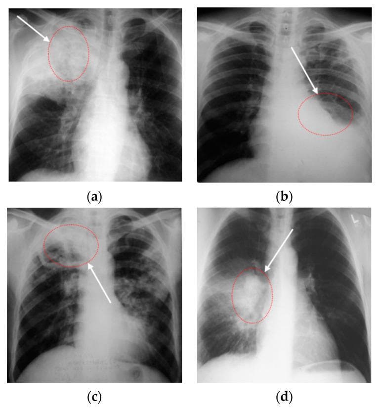 A set of four posterior-anterior (PA) chest X-ray radiographs (labeled a-d) demonstrating various manifestations of pulmonary tuberculosis. Image (a) shows dense consolidation in the right upper lobe containing radiolucent areas consistent with cavitary lesions. Image (b) illustrates tuberculous exudative pleurisy, characterized by a homogeneous basal opacity with a meniscus sign on the left side, indicating significant pleural effusion. Image (c) depicts secondary tuberculosis in the right upper lung, presenting as a large, heterogeneous, ill-defined opacity with associated pulmonary infiltrates. Image (d) demonstrates right hilar consolidation with prominent hilar lymphadenopathy, seen as rounded, increased densities in the mediastinal region. These diagnostic images highlight key radiological features of tuberculosis, including parenchymal consolidation, cavitation, pleural involvement, and hilar node enlargement, which are essential for clinical diagnosis and staging of the disease in infectious disease and radiology contexts.