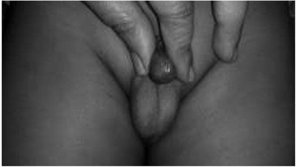 This grayscale clinical photograph depicts a physical examination of the pediatric male genitalia, demonstrating a non-retractile prepuce consistent with Grade 4 phimosis on the Kikiros scale. The image shows a clinician's fingers attempting to retract the foreskin. There is minimal retraction, with the preputial orifice remaining narrow and constricted. Only a small portion of the glans penis is visible through the stenotic opening of the foreskin. The surrounding inguinal and scrotal skin appears normal without evidence of inflammation or secondary lesions. This visual represents a diagnostic evaluation of pathological or physiological phimosis in a pediatric patient, emphasizing the clinical assessment of preputial mobility and the degree of urethral meatus exposure.