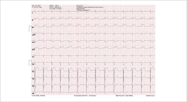 This diagnostic image is a 12-lead electrocardiogram (ECG) demonstrating an acute inferior wall ST-segment elevation myocardial infarction (STEMI). The tracing exhibits significant ST-segment elevation in the inferior leads (II, III, and aVF). Reciprocal ST-segment depression is visible in the high lateral leads (I and aVL). The QRS complexes demonstrate a primarily upright morphology with visible R and S waves, and the overall rhythm is consistent with a sinus origin at a normal rate. These findings are clinically pathognomonic for an acute coronary syndrome, specifically involving the occlusion of the right coronary artery (RCA) or the left circumflex artery. The image serves as a critical educational tool for recognizing primary ischemic changes and reciprocal electrical patterns in cardiology. Additional features include a normal axis and morphological signs that may suggest an incomplete right bundle branch block (IRBBB) as noted in the machine interpretation.