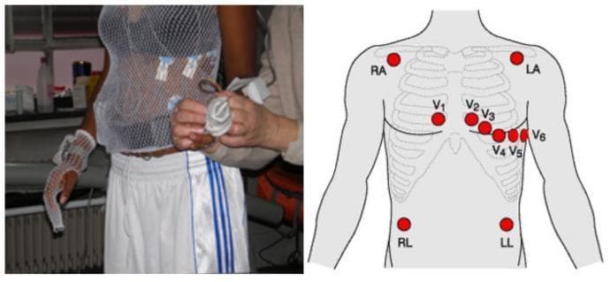 This composite educational material consists of a clinical photograph and a corresponding anatomical diagram illustrating the placement of a standard 12-lead electrocardiogram (ECG) for a cardiac stress test. On the left, a clinical photograph shows a female athlete wearing a white, see-through tubular mesh top designed to secure ECG electrodes and wiring against the skin during physical exertion. The electrodes are visible beneath the mesh, connected to thin leads. On the right, a schematic anatomical diagram of the human torso displays the precise locations for ten electrodes. The limb leads are labeled RA (Right Arm), LA (Left Arm), RL (Right Leg), and LL (Left Leg). The six precordial leads (V1–V6) are shown in their standard positions: V1 and V2 at the fourth intercostal space on either side of the sternum, V4 at the fifth intercostal space in the midclavicular line, and V3, V5, and V6 following the anatomical contour of the chest. This resource demonstrates the clinical preparation required for ergospirometry and cardiovascular monitoring.