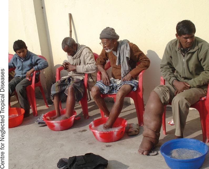 A clinical photograph depicting four male patients seated in a row, participating in foot hygiene practices for the management of lymphatic filariasis. The patients are seated in plastic chairs, each with their lower limbs positioned in basins containing soapy water. The individual on the far right exhibits advanced elephantiasis of the right lower extremity, characterized by massive non-pitting lymphedema, significant limb distortion, and skin thickening (pachydermia) with visible skin folds. Other patients show varying degrees of lower limb involvement or are engaged in preventive hygiene. The scene illustrates morbidity management and disability prevention (MMDP) protocols, specifically focusing on local skin care and hygiene to prevent secondary bacterial infections (dermatolymphangioadenitis) in patients with neglected tropical diseases (NTDs). The setting appears to be a community-based health intervention in a region endemic for Wuchereria bancrofti or Brugia malayi.