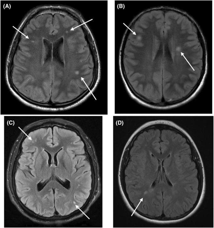 Diagnostic Image: A composite of four axial brain MRI slices using T2-weighted Fluid-Attenuated Inversion Recovery (FLAIR) sequences (A–D). The images demonstrate multifocal areas of signal prolongation (hyperintensity) within the cerebral white matter. White arrows identify specific lesions that vary in size, morphology, and distribution. (A) Multiple punctate and small patch-like lesions are visible in both subcortical and periventricular white matter. (B) Fewer, but larger and more confluent-appearing hyperintense foci are situated near the frontal and posterior horns of the lateral ventricles. (C) Shows a cluster of hyperintensities in the frontal subcortical white matter and a small punctate lesion in the posterior region. (D) Demonstrates a solitary, discrete hyperintense lesion in the deep white matter. These findings illustrate characteristic white matter signal abnormalities associated with Down syndrome-related regression disorder (DSRD). This material is intended for intermediate to advanced medical learners studying neuroradiology and neurodevelopmental pathology.