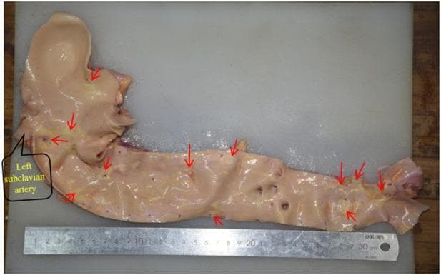 This clinical photograph displays a gross pathological specimen of a human aorta, dissected longitudinally to expose the intimal surface. The specimen includes the aortic arch, descending thoracic aorta, and abdominal aorta, positioned alongside a centimeter ruler for scale. The tissue exhibits a light tan to pinkish coloration with visible branching vessels, including a labeled 'Left subclavian artery' at the proximal end. Numerous red arrows highlight the focal distribution of atherosclerotic disease. Yellowish, irregular, and raised hardened plaques are clearly visible, demonstrating the progression from fatty streaks to more advanced calcified or fibrous lesions. These plaques are particularly concentrated around the ostia of vascular branches, such as the subclavian artery and distal bifurcation areas. The image serves as a teaching tool for cardiovascular pathology, illustrating the gross morphology of aortic atherosclerosis and its predilection for arterial branching points and the distal abdominal segment.