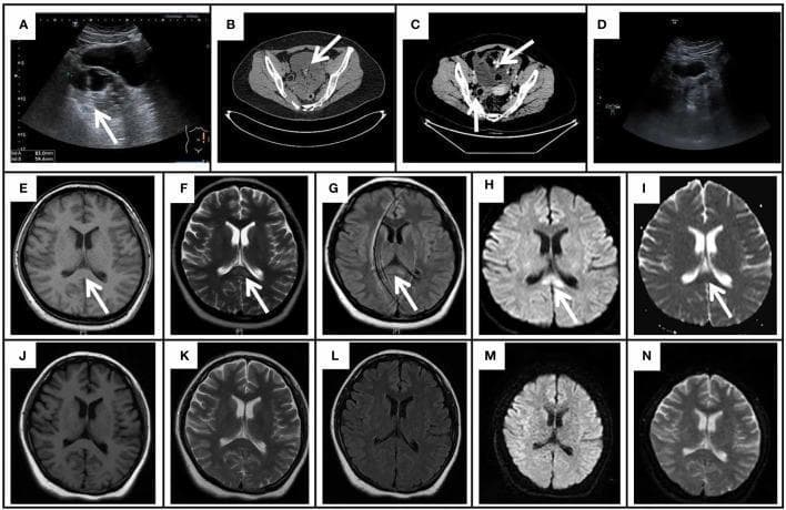 This composite figure presents gynecological ultrasound, pelvic CT, and cranial MRI findings associated with anti-NMDAR encephalitis and ovarian teratoma. (A) Ultrasound shows a 8.3x5.9 cm mixed echogenic left adnexal mass. (B-C) Pelvic CT images reveal a large (10.2x8.4 cm), irregular cystic-solid mass in the posterior bladder and anterior uterine regions, containing fat and calcification components, characteristic of a teratoma. (D) Follow-up ultrasound shows post-surgical resolution. (E-I) Initial axial cranial MRI shows a focal lesion in the splenium of the corpus callosum (SCC) marked by arrows. The lesion is slightly hypointense on T1WI (E), hyperintense on T2WI (F), FLAIR (G), and DWI (H), with corresponding hypointensity on the ADC map (I), suggesting cytotoxic edema. (J-N) Repeated MRI on day 52 demonstrates complete resolution of the SCC lesion across all sequences (T1WI, T2WI, FLAIR, DWI, ADC). This imaging sequence illustrates a Cytotoxic Lesion of the Corpus Callosum (CLOCCs) associated with paraneoplastic autoimmune encephalitis.
