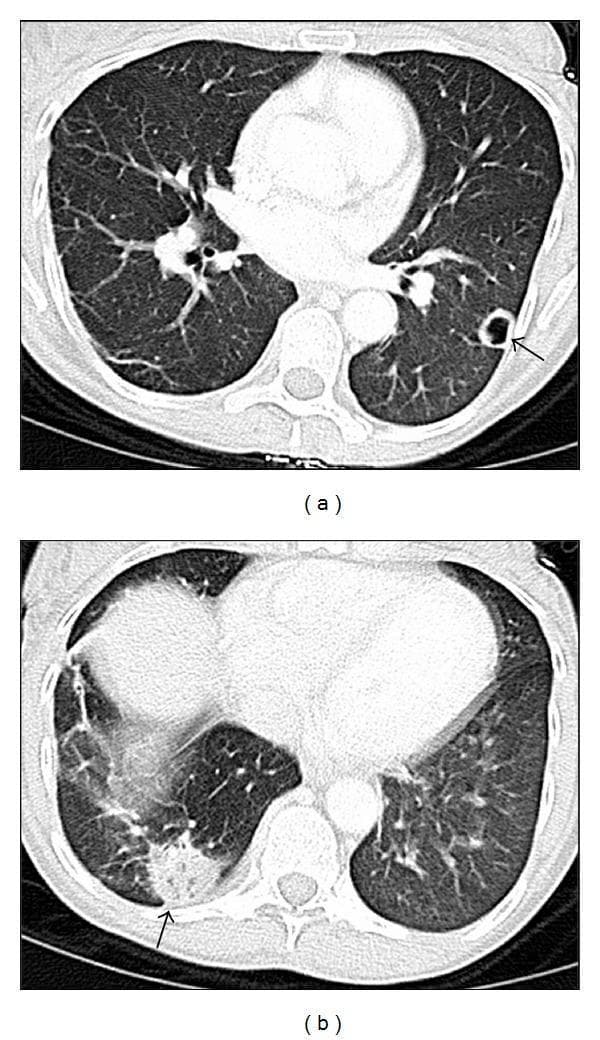 Two axial CT scan slices of the chest in lung window demonstrate multifocal pulmonary pathology. Panel (a) shows a 1.7 cm cavitary nodule (indicated by an arrow) located peripherally in the left lower lobe. The nodule features a relatively thick wall and a central area of lucency, suggesting necrosis or cavitation. Panel (b) reveals a larger 3 cm mass-like infiltrate or consolidation (indicated by an arrow) in the right lower lobe, also positioned peripherally near the pleural surface. The infiltrate displays irregular borders and increased density compared to normal lung parenchyma. These findings are characteristic of infectious processes such as disseminated mycobacterial infection (e.g., Mycobacterium fortuitum) or nocardiosis, which often manifest with peripheral nodules, cavitation, and multifocal pneumonia in immunocompromised or critically ill patients. The image is suitable for medical education in pulmonology, radiology, and infectious diseases.