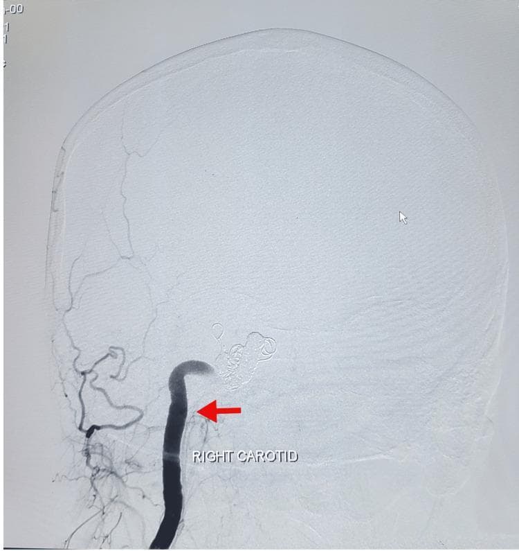 This diagnostic image is a post-operative Digital Subtraction Angiography (DSA) of the head and neck in a lateral view. The image highlights the right carotid artery, which is opacified with dark contrast material and indicated by a red arrow labeled 'RIGHT CAROTID'. At the distal aspect of the carotid artery, near the cavernous sinus region, there is a dense cluster of radio-opaque embolic coils, consistent with a parent artery occlusion for the treatment of a carotid-cavernous fistula (CCF). The surrounding cerebral vasculature appears less opacified, indicating modified hemodynamics post-embolization. The bony structures of the skull and facial bones are visible in a faint, subtracted grayscale background, providing anatomical landmarks for the vascular pathology. This image demonstrates the result of endovascular neurosurgery using metallic coils to achieve therapeutic occlusion of a high-flow vascular shunt.