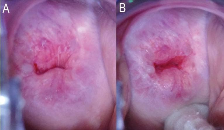 Two side-by-side colposcopic clinical photographs (A and B) demonstrating the assessment of the Transformation Zone (TZ) and Squamocolumnar Junction (SCJ) of the human cervix. In Image A, the cervix shows a pinkish, smooth ectocervix with a partially obscured SCJ, where the upper limit of the junction disappears into the endocervical canal without manipulation. This is categorized as TZ Type 3A because the entire circumference of the SCJ is not visible. In Image B, the same cervix is shown while a cotton-tipped applicator is used to exert pressure on the posterior fornix, successfully exposing the endocervical canal. This maneuver reveals the entire circumference of the SCJ, which is found to extend less than 5 mm into the canal, reclassifying the finding as TZ Type 2A. These images illustrate the importance of clinical manipulation techniques in cervical cancer screening to differentiate between patients eligible for ablative therapy (TZ 1 and 2) versus those requiring excisional procedures (TZ 3).