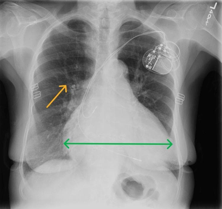 A frontal (posteroanterior) chest radiograph demonstrating significant cardiomegaly and signs of pulmonary congestion. The cardiac silhouette is markedly enlarged, with the cardiothoracic ratio exceeding 50%, as highlighted by a green double-headed horizontal arrow across the maximum transverse diameter of the heart. In the upper left chest wall, a permanent pacemaker is visible with leads extending toward the right atrium and right ventricle. The lung fields show increased interstitial markings and cephalization of the pulmonary vessels, particularly in the right mid-lung zone (indicated by an orange arrow), consistent with mild pulmonary vascular congestion or volume overload. Small metallic surgical clips are noted in the left axillary/chest wall region. This diagnostic image is intended to illustrate the radiographic presentation of heart failure with reduced ejection fraction (HFrEF) and chronic volume overload in a clinical setting.