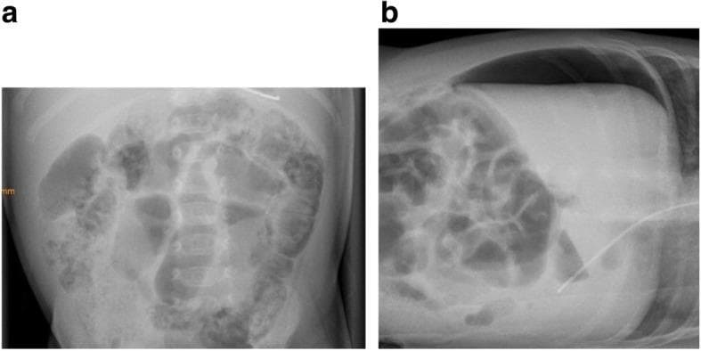 Two radiographic panels illustrating the progression of necrotizing enterocolitis (NEC) in a pediatric patient. Panel A is a supine abdominal X-ray demonstrating pneumatosis intestinalis. This is characterized by the presence of intramural gas, visualized as linear and curvilinear radiolucencies (bubbles) outlining the walls of the large bowel loops. Panel B is a left lateral decubitus X-ray from the same patient eight days later, showing progression to intestinal perforation. The image clearly depicts a large volume of pneumoperitoneum (free intraperitoneal air), most evident as a prominent crescentic radiolucency in the suprahepatic space, situated between the liver surface, the anterior abdominal wall, and the right hemidiaphragm. These findings represent classic radiographic stages of NEC (Bell Stages IIa and IIIb), critical for diagnosing bowel ischemia and subsequent surgical emergency in neonatal and pediatric populations.