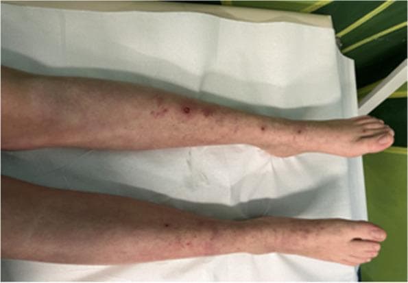This clinical photograph displays the bilateral lower extremities of a patient, specifically from the mid-calf to the feet, showcasing the resolution phase of a dermatological condition. The skin presents with a predominantly purpuric and petechial rash. Key visible lesions include small, pinpoint reddish-purple petechiae and larger, palpable purpuric papules scattered along the anterior and lateral aspects of the legs. The morphology of the rash suggests small-vessel vasculitis, such as IgA vasculitis (formerly Henoch-Schönlein purpura), showing signs of fading following medical intervention. Some areas exhibit faint, dusky discoloration consistent with post-inflammatory changes or healing bruises. The distribution is notably symmetric and gravitates toward the distal limbs, a classic presentation for systemic leukocytoclastic vasculitis patterns. This image serves as a clinical example of cutaneous vasculitis progression and its visual response to corticosteroid therapy.