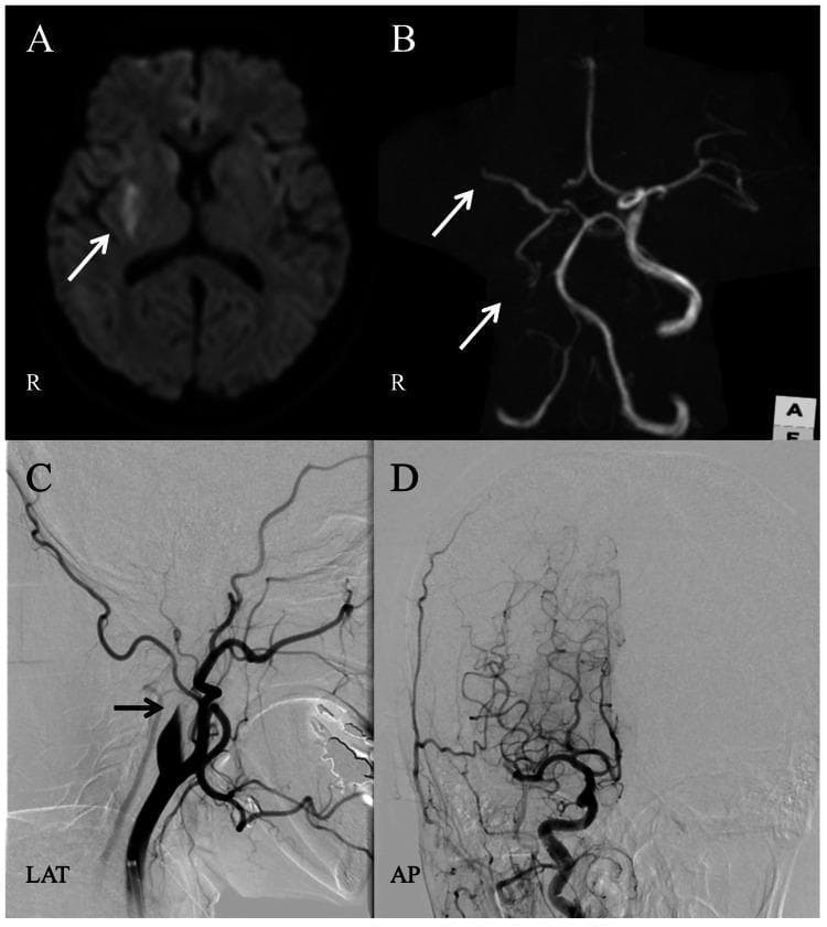 Cerebral imaging panel demonstrating acute ischemic stroke and its endovascular management. Panel A: Axial diffusion-weighted imaging (DWI) showing an area of hyperintensity (restricted diffusion) in the right putamen and corona radiata, consistent with acute infarction. Panel B: Time-of-flight magnetic resonance angiography (MRA) showing a signal void in the right internal carotid artery (ICA) and middle cerebral artery (MCA), indicating proximal occlusion. Panel C: Digital subtraction angiography (DSA) of the right carotid artery in lateral (LAT) view, confirming an abrupt cutoff at the cervical ICA. Panel D: Post-thrombectomy DSA in anterior-posterior (AP) view, demonstrating partial recanalization of the right ICA and restoration of distal intracranial flow. This sequence illustrates the radiological diagnosis of large vessel occlusion (LVO) and the immediate vascular outcome following mechanical thrombectomy in stroke neurology.