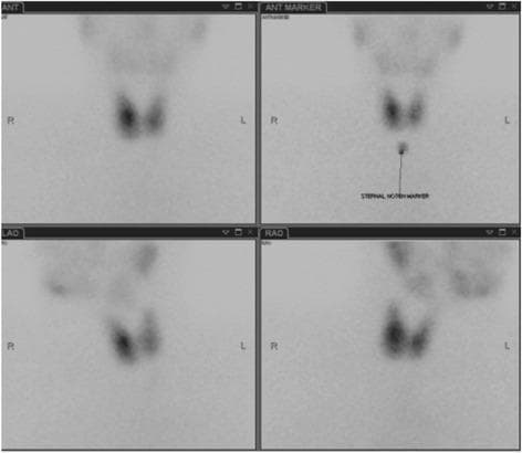 This diagnostic image set displays a radionuclide thyroid scintigraphy (Technetium-99m scan) of a human thyroid gland, presented in four distinct views: Anterior (ANT), Anterior with Marker (ANT MARKER), Left Anterior Oblique (LAO), and Right Anterior Oblique (RAO). The scan shows a normal-sized, bilobed thyroid gland with a characteristic butterfly shape. There is a diffuse and homogeneous distribution of radiotracer uptake throughout both the right and left lobes, with no focal 'hot' (hyperfunctioning) or 'cold' (non-functioning) nodules detected. In the 'ANT MARKER' panel, a 'STERNAL NOTCH MARKER' is positioned inferiorly to provide an anatomical reference for the gland's position in the neck. The images also demonstrate physiological tracer accumulation in the salivary glands and oral cavity, visible superior to the thyroid. This scintigraphic study is used to evaluate thyroid morphology and functional status, particularly in the clinical context of hyperthyroidism or thyroiditis.