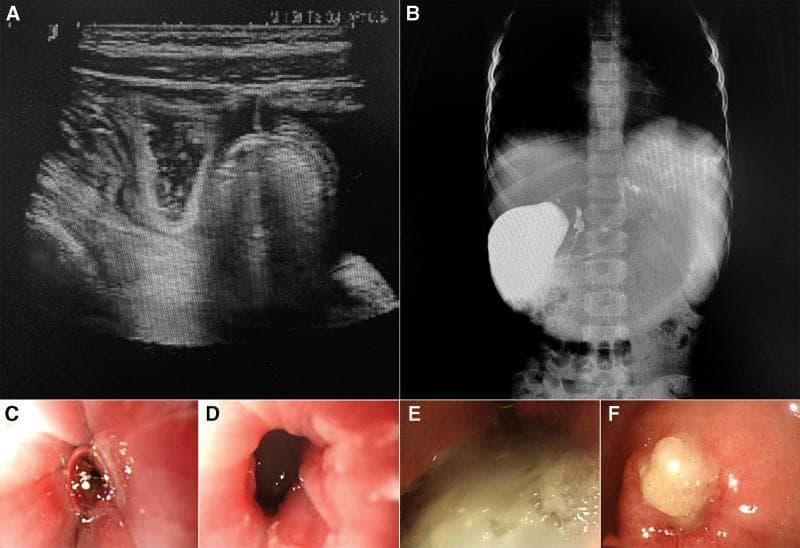 This composite figure illustrates diagnostic findings of gastric outlet obstruction and peptic ulcer disease using multiple imaging modalities. (A) Abdominal ultrasound shows a distended stomach with heterogeneous hyperechoic and hypoechoic material, indicating significant postprandial gastric retention. (B) Upper gastrointestinal barium meal X-ray demonstrates a markedly dilated stomach with a large collection of contrast medium and poor distal passage, suggesting pyloric stenosis. (C–F) Gastroscopic images provide internal visualization of the gastric lining and pyloric region. Image (C) shows an ulcer near the cardia with white exudate (moss). Image (D) reveals a narrowed pyloric lumen (stenosis) with surrounding inflammatory changes. Images (E) and (F) demonstrate active ulcers in the gastric sinus and pylorus, characterized by thick white-yellow purulent-like exudate, mucosal congestion, and edematous margins. These images collectively document the progression from functional gastric retention to the mechanical obstruction and structural mucosal damage characteristic of chronic ulceration and pyloric scarring.