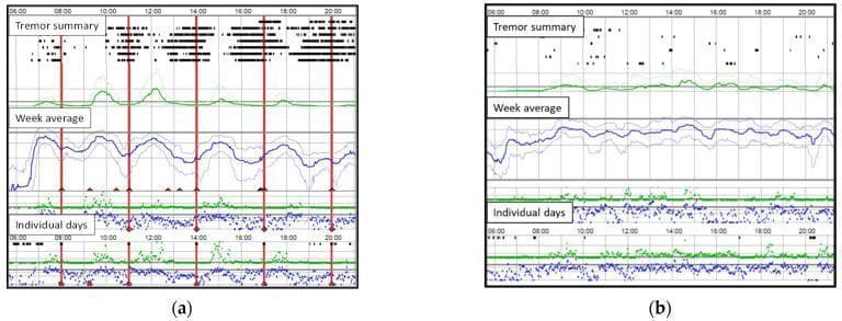 This diagnostic comparison chart displays two Parkinson’s KinetiGraph (PKG) recordings, (a) and (b), used to objectively monitor Parkinson's disease motor symptoms over a 24-hour timeframe (06:00 to 20:00). Each panel contains three primary sections: 'Tremor summary,' 'Week average,' and 'Individual days.' Panel (a) illustrates a 'wearing-off' phenomenon, characterized by dense black clusters in the Tremor summary and significant fluctuations in the Week average blue line (representing bradykinesia scores). These fluctuations correspond with vertical red lines indicating medication administration times, showing a cyclical pattern of symptom worsening before each dose. Panel (b) depicts a stable clinical state with minimal tremor activity and a relatively flat Week average line, indicating well-controlled motor symptoms without objective evidence of wearing-off. The PKG provides a continuous, quantitative assessment of bradykinesia and dyskinesia, aiding clinicians in adjusting dopaminergic therapies such as levodopa infusions. Key educational concepts include motor fluctuations, objective symptom monitoring, and the visualization of levodopa dose-response relationships.