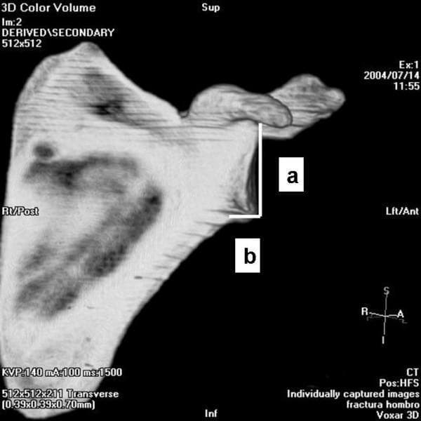 This diagnostic image features a 3D color volume reconstruction from a Computed Tomography (CT) scan of a human scapula, presented in an anterior-lateral orientation. Labeled anatomical landmarks include the superior (Sup) and inferior (Inf) borders, with directional markers indicating right/posterior (Rt/Post) and left/anterior (Lft/Ant) aspects. The image demonstrates specific morphometric measurements used to calculate the inferior glenoid neck index. Measurement 'a' is a vertical line representing the articular glenoid surface measure, extending from the superior margin of the glenoid fossa. Measurement 'b' is a horizontal line measuring the distance from the articular glenoid surface to the anterior column of the scapula. These perpendicular lines are used in orthopedic radiology to categorize scapular anatomy into 'short-neck' or 'long-neck' clusters, which has clinical significance for shoulder arthroplasty and fracture management. The coracoid process is clearly visible extending anteriorly, and the glenoid fossa is oriented towards the viewer.