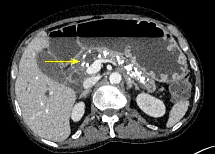 Axial contrast-enhanced CT scan of the abdomen demonstrating classic features of chronic pancreatitis. The primary diagnostic finding is the presence of multiple, coarse, hyperdense parenchymal calcifications (foci of high attenuation) distributed throughout the head, body, and tail of the pancreas. A yellow arrow points specifically to dense calcifications in the pancreatic head/groove region. The pancreas appears somewhat atrophic with irregular margins, indicative of long-standing inflammatory changes. Surrounding anatomical structures include the liver (right), spleen (left), a vertebra with its neural arch (center-bottom), and the stomach containing air-fluid levels (anterior). This imaging is characteristic of end-stage chronic pancreatitis, often associated with long-term alcohol use or metabolic disorders, and serves as a key diagnostic indicator for irreversible parenchymal damage.