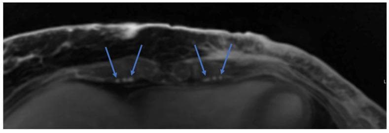 This diagnostic image is an axial cross-section of a chest Magnetic Resonance Angiography (MRA) scan. The view focuses on the anterior thoracic wall, showing the sternum, subcutaneous fat, and muscle layers. The primary clinical focus is the identification of recipient vessels for microsurgical anastomosis in preoperative planning for autologous breast reconstruction (e.g., DIEP flap). Blue arrows bilaterally indicate the internal mammary veins, which appear as hyperintense (bright), small, circular structures located adjacent to the internal mammary arteries. The image demonstrates the spatial relationship and caliber of these thoracic vessels relative to the intercostal spaces and sternal border. This imaging modality is used to assess the viability and anatomic course of the internal mammary system to ensure successful microvascular outcomes during reconstructive surgery.