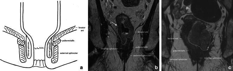 This composite educational image illustrates the pelvic floor and anal canal anatomy and its clinical relevance in rectal cancer staging. Panel (a) is an anatomical diagram depicting the coronal view of the anal canal, highlighting the levator ani, puborectalis muscle, external sphincter, and internal sphincter, with a dashed line marking the intersphincteric plane. Panel (b) is a coronal T2-weighted MRI showing a cT3a rectal tumor in a male patient. An arrow indicates irregular wall thickening with minimal (±1 mm) perirectal extension invading the right internal anal sphincter. Panel (c) is a coronal T2-weighted MRI of a female patient with a cT4b rectal tumor. The tumor (outlined by a dashed line) shows extensive infiltration, invading both internal sphincters and extending into the external sphincter, levator ani, and puborectalis muscles on the left side. Muscles and sphincters appear characteristically hypointense on T2 imaging, while the tumor presents as an intermediate-signal mass disrupting normal anatomical boundaries, essential for determining surgical management such as abdominoperineal resection.