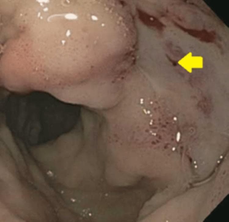 This endoscopic clinical photograph displays the internal mucosal surface of the duodenal bulb during an esophagogastroduodenoscopy (EGD). The primary finding is a large, cratered duodenal ulcer characterized by mucosal architectural disruption and erythema. A yellow arrow points to a prominent, non-bleeding visible vessel (Forrest Class IIa) located within the ulcer base, which represents a high-risk stigmata of recent hemorrhage. The surrounding duodenal mucosa is diffusely erythematous and edematous, showing scattered petechiae and small spots of oozing blood, indicative of active inflammation and recent bleeding. Bubbles of gastric/duodenal secretions are visible on the mucosal surface, and the distal lumen is partially visualized in the background. This image is an essential educational resource for identifying endoscopic risk factors for recurrent peptic ulcer bleeding and for training in Forrest classification for gastrointestinal pathology.