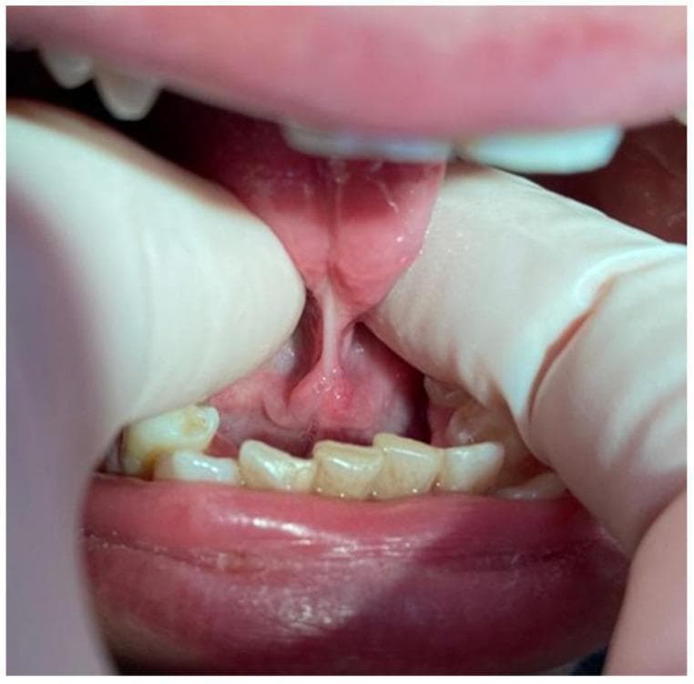 This clinical intraoral photograph demonstrates a case of severe ankyloglossia, commonly referred to as a 'tongue-tie.' The image captures the ventral surface of the tongue being elevated by gloved fingers to reveal a short, thick, and fibrous lingual frenulum. This connective tissue band attaches the underside of the tongue close to its apex to the floor of the mouth, significantly restricting the tongue's range of motion. The frenulum appears taut and under tension, creating a visible pull on the sublingual tissues. The surrounding anatomy includes the lower mandibular incisors, which show signs of crowding and mild extrinsic staining. The floor of the mouth exhibits healthy pink mucosa with visible vasculature, although the focal point is the pathologically short frenulum, estimated at less than 7 mm based on clinical severity grading. This visual is characteristic of Class III or IV ankyloglossia, which can impact speech, deglutition, and oral hygiene in pediatric and adult patients.