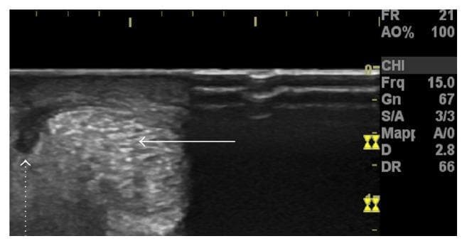 High-resolution cross-sectional (axial) ultrasound image of the Achilles tendon. The main body of the tendon (indicated by a solid white arrow) exhibits a heterogeneous echotexture with a mixture of hyperechoic and hypoechoic areas, representing its normal fibrous architecture under pathological stress. Laterally to the tendon body, a prominent hypoechoic, nearly anechoic region is visible (indicated by a dotted white arrow), which represents a peritendinous fluid collection. This finding is characteristic of acute paratendinopathy, where fluid accumulates between the tendon and its surrounding paratenon. The image serves as a clinical diagnostic example of musculoskeletal ultrasound used to differentiate between isolated tendinopathy and paratenon involvement in acute calf injuries.