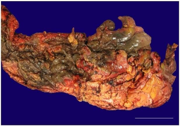 Clinical photograph of a gross pathological surgical specimen consisting of debrided necrotic tissue, measuring 44 x 17 x 4 cm. The tissue displays significant macroscopic signs of necrotizing fasciitis, characterized by a heterogeneous and severely damaged appearance. Visible pathology includes extensive liquefactive and coagulative necrosis, with color variations ranging from pale gray and greenish-yellow to dark brown and black gangrenous areas. Interspersed regions of red discoloration suggest underlying hemorrhage and acute inflammation. The specimen's texture is highly irregular and granular, showing destruction of the subcutaneous adipose tissue and fascia. The educational focus is on identifying the gross characteristics of Stage III necrotizing fasciitis (associated with Streptococcus constellatus in this case) and the massive extent of tissue devitalization that necessitates urgent surgical intervention. This image is relevant for surgical pathology, infectious disease, and emergency medicine education regarding soft tissue infections and septic shock.