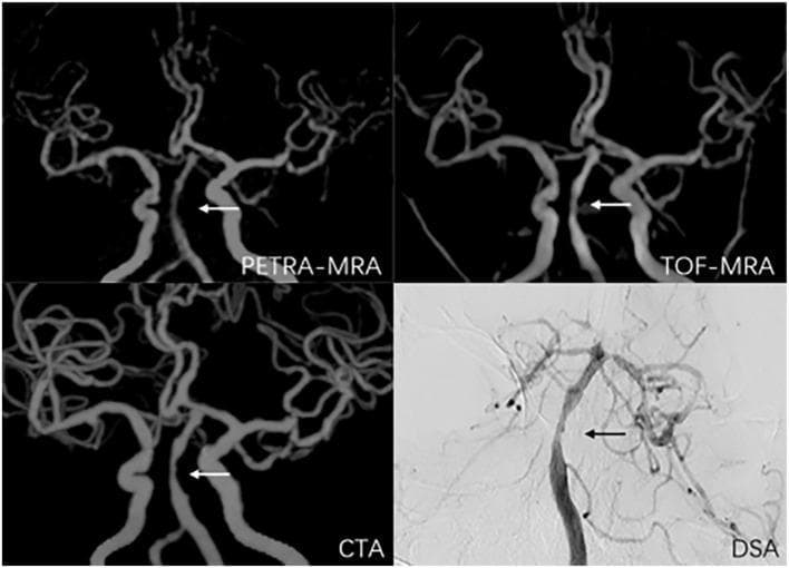 This diagnostic comparison chart displays a 2x2 grid of intracranial vascular imaging modalities in a 56-year-old male. The modalities include Pointwise Encoding Time Reduction with Radial Acquisition Magnetic Resonance Angiography (PETRA-MRA), Time-of-Flight MRA (TOF-MRA), Computed Tomography Angiography (CTA), and Digital Subtraction Angiography (DSA). Each image provides an anterior view of the intracranial vasculature, focusing on the Circle of Willis and its major branches. A focal lesion demonstrating symptomatic basilar artery stenosis is identified by arrows in all four panels. The PETRA-MRA, TOF-MRA, and CTA panels show three-dimensional reconstructions with bone removal, highlighting the varying degrees of focal luminal narrowing (ranging from 51.1% to 69.7% across modalities). The DSA panel serves as the gold-standard two-dimensional projection, showing high-contrast opacification of the basilar artery and posterior circulation. This comparison illustrates the diagnostic performance, contrast resolution, and morphological assessment of intracranial atherosclerotic disease across different non-invasive and invasive imaging techniques.