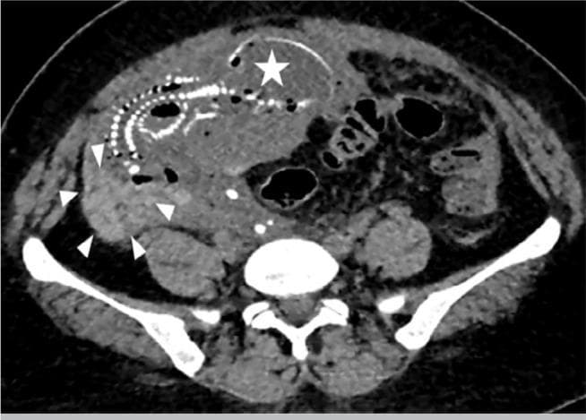 This axial abdomino-pelvic computed tomography (CT) scan illustrates a rare case of advanced extrauterine abdominal pregnancy. The imaging shows a fetus located within the abdominal cavity, separate from the uterus. A white star marks the fetal skull, which exhibits signs of fetal demise such as Spalding's sign (overlapping of cranial bones). The ossified fetal spine is visible as a series of hyperdense vertebral bodies curving through the mid-abdomen. White arrowheads delineate the placenta, which is abnormally implanted onto abdominal structures rather than the uterine wall. There is evidence of significant hemoperitoneum, visualized as high-attenuation free fluid surrounding the abdominal viscera and collecting in the paracolic gutters. This diagnostic image serves as an educational example of the radiological presentation of a secondary abdominal pregnancy, highlighting the displacement of bowel loops and the absence of surrounding myometrium around the gestational sac.