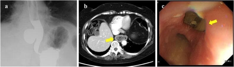 This composite figure displays diagnostic findings for a 50-mm epiphrenic diverticulum located in the lower thoracic esophagus. Panel (a) is a contrast esophagogram (barium swallow) showing a prominent, saccular outpouching on the right wall of the distal esophagus, approximately 5 cm above the esophagogastric junction. Panel (b) is an axial contrast-enhanced CT scan of the lower mediastinum identifying the diverticulum (indicated by a yellow arrow) as a distinct, air- and fluid-filled structure adjacent to the esophageal lumen. Panel (c) provides an endoscopic view showing the large diverticular orifice (yellow arrow) within the lower esophagus, containing visible food residue. The surrounding esophageal mucosa appears erythematous, consistent with mild reflux esophagitis. Together, these images illustrate the radiographic, tomographic, and endoscopic features of a pulsion-type esophageal diverticulum, which is frequently associated with esophageal motility disorders like EGJ outflow obstruction.