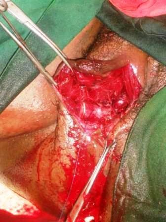 This clinical photograph shows an intraoperative view of the female perineal region following the evacuation of a vulvar hematoma. The image displays an open surgical site with a deep residual cavity between the superficial and deep fascial planes of the perineum. The tissue within the cavity appears saturated with blood, showing various shades of red and clotted material. Metallic surgical instruments are in use: a clamp or forceps is retracting the superior edge of the tissue to improve visualization of the deep space, while a needle holder is visible near the inferior aspect of the wound, likely performing hemostatic suturing. Visible sutures are present within the muscle and connective tissue layers. The surrounding skin is draped with green surgical cloths and shows evidence of blood staining and previous tension. This visual demonstrates the surgical management of a postpartum vulvar hematoma, focusing on the debridement, evacuation of the clot, and preparation for hemostatic closure or dead-space obliterating sutures.