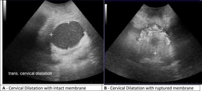 This diagnostic image consists of two side-by-side transperineal ultrasound frames in the transverse plane, comparing cervical dilatation in laboring patients. Image A displays cervical dilatation with intact membranes. The cervical canal appears as a clear, well-defined, anechoic (dark) oval space, indicating the presence of amniotic fluid within the intact sac. Four white '+' electronic calipers are placed at the anterior, posterior, and lateral margins of the cervical rim to measure the anterior-posterior (AP) and transverse diameters. Image B displays cervical dilatation with ruptured membranes. In this state, the cervical canal lacks the clear anechoic fluid space and instead shows a heterogeneous, more echogenic (brighter) appearance, likely due to the direct visualization of the fetal presenting part (scalp/hair) against the cervical tissue. Similar '+' markers are used to delineate the boundaries for measurement. This comparison illustrates the sonographic differences in the appearance of the birth canal during different stages of membrane status, serving as a non-invasive method for monitoring labor progress.