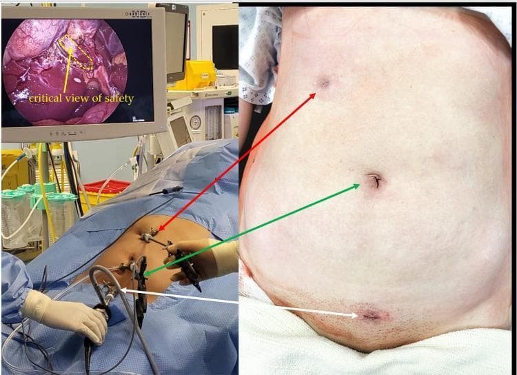This composite clinical photograph and diagnostic display illustrate the setup and outcome of an 'Emirate' laparoscopic cholecystectomy. The image is divided into three sections: an intraoperative view, a laparoscopic monitor display, and a postoperative abdominal photograph. The laparoscopic monitor (top left) shows the 'critical view of safety' during dissection, with a yellow dashed line highlighting the hepatocystic triangle (Calot's triangle) and an arrow pointing to the cystic duct and artery area. The intraoperative photograph (bottom left) demonstrates the unique three-port placement: a 5mm intraumbilical port, a 5mm right subcostal port, and a 5mm suprapubic port. The postoperative image (right) shows the corresponding healed 5mm incisions, emphasizing the cosmetic advantage and reduced visibility of scars in the umbilical, right hypochondrium, and suprapubic regions. The content is designed for surgical education, focusing on minimally invasive techniques, anatomical landmarks for safe gallbladder removal, and port-site optimization to minimize postoperative scarring and hernia risk.