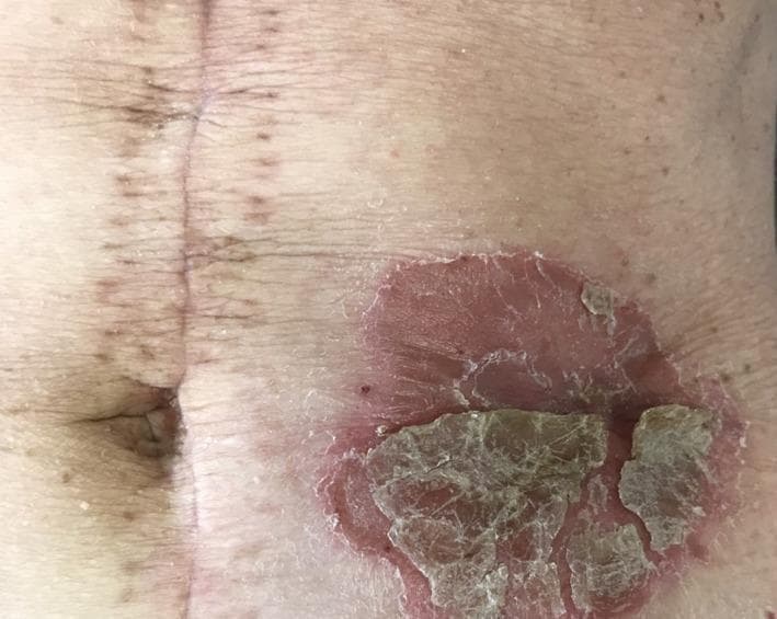 This clinical photograph displays a primary dermatological lesion on the human abdomen, specifically a well-demarcated peristomal plaque. The lesion is a large, circular, erythematous (reddish) plaque characterized by sharply defined borders that distinguish it from the healthy surrounding skin. The surface exhibits significant desquamation, with thick, micaceous (silvery), and yellowish-brown scales, many of which are flaky and partially peeling. The plaque is situated on the left abdominal wall adjacent to a stoma site. Medially to the lesion, a vertical surgical midline incision scar is visible, showing post-operative hyperpigmentation and healing markers. The surrounding abdominal skin shows signs of chronological aging or sun damage, including fine rhytids and scattered lentigines. This image illustrates the Koebner phenomenon or peristomal psoriasis, emphasizing the typical morphology of psoriatic lesions in areas of chronic mechanical irritation or localized skin trauma.