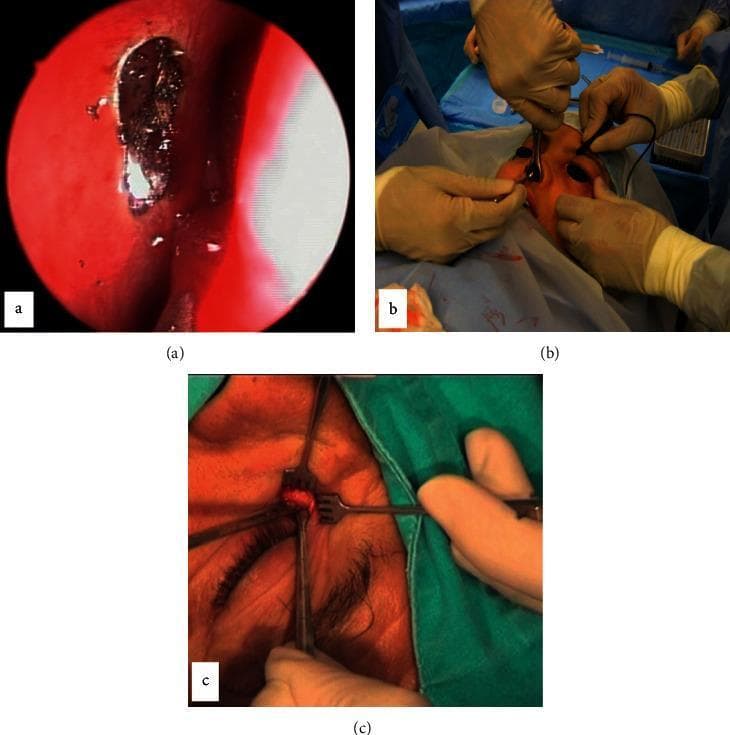 This composite of three intraoperative images illustrates different surgical approaches for dacryocystorhinostomy (DCR) to treat lacrimal duct obstruction. Image (a) displays a Transcanalicular Laser DCR (TCL-DCR), showing an endoscopic endonasal view with a focal area of laser-induced thermal ablation on the nasal mucosa, characterized by carbonization and localized hemorrhage. Image (b) depicts Non-Endoscopic Endonasal DCR (NEN-DCR), showing an external operating room perspective where surgeons use headlights and manual instruments to access the lacrimal sac through the nasal cavity. Image (c) shows External DCR (EXT-DCR), featuring a close-up of a cutaneous nasojugal incision. This view demonstrates the use of self-retaining retractors and forceps to expose the underlying lacrimal sac and periosteum for the creation of mucosal flaps. The sequence highlights the variation in invasiveness, from minimally invasive endoscopic laser techniques to traditional open external surgery.