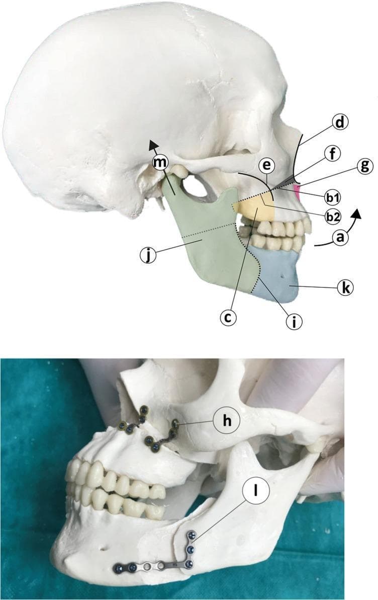 This medical illustration and corresponding clinical model photograph demonstrate the surgical steps of a bimaxillary advancement procedure with counter-clockwise rotation (BRA). The top diagram illustrates a modified Le Fort I osteotomy involving the resection of a cuneiform (wedge-shaped) bone fragment (f) from the anterior maxilla. This resection extends from the piriformis aperture (d) to the zygomatic-alveolar arch (e), with the maximum height at the aperture. A V-shaped osteotomy of the anterior nasal process (g) is indicated to prevent nasal septum compression. For the mandible, an Obwegeser-Dalpont sagittal split osteotomy (i) is shown, dividing the bone into a posterior (j) and anterior (k) segment, allowing for the advancement and cranial alignment (m) of the articular process. The bottom photograph shows the post-osteotomy fixation on a skull model. Rigid fixation of the maxilla is achieved using L-shaped mini-osteosynthesis plates (h) secured with four screws each. The mandibular segments are stabilized using a semirigid osteosynthesis miniplate (l) with multiple mini-screws. This procedure is commonly utilized in oral and maxillofacial surgery to treat obstructive sleep apnea (OSA) by expanding the pharyngeal airway.