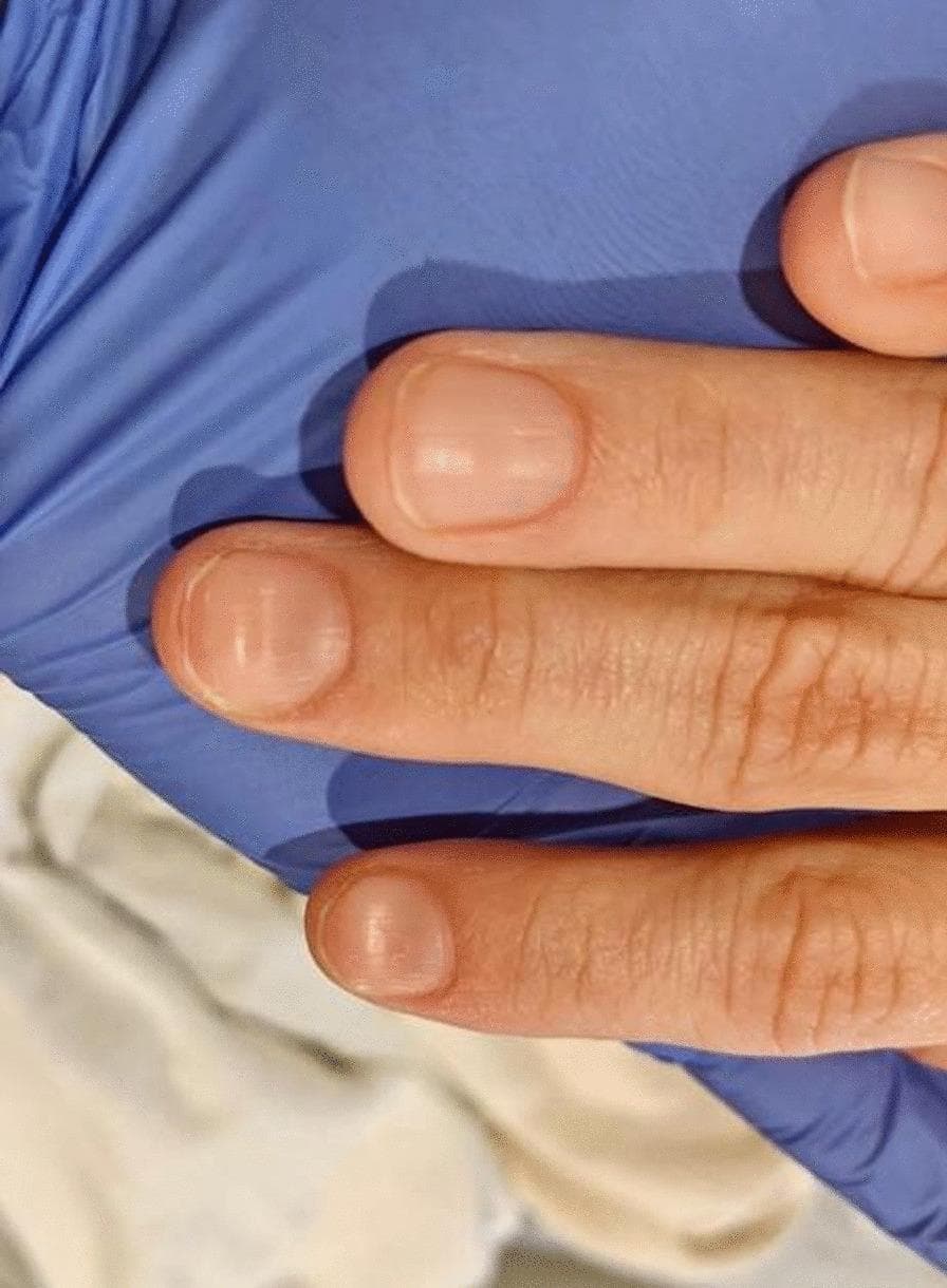 This clinical photograph displays the dorsal surface of three fingers from a patient's hand, demonstrating koilonychia. The nails exhibit a classic 'spoon-shaped' deformity characterized by the loss of normal convexity, resulting in a flattened or centrally concave nail plate with raised lateral and distal edges. The nail plates appear thin and slightly pale, consistent with hypochromic states. The surrounding periungual skin and cuticles appear intact without significant inflammation, paronychia, or splinter hemorrhages. This finding is a pathognomonic physical sign often associated with chronic iron deficiency anemia (Plummer-Vinson syndrome) or other systemic conditions affecting keratinization. The image serves as an educational reference for identifying dermatological manifestations of hematologic disorders during a physical examination.