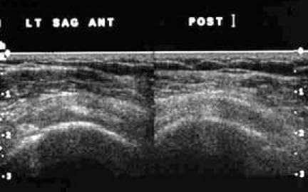 This grayscale diagnostic ultrasound image displays a transverse (short-axis) view of the musculoskeletal structures of the shoulder, specifically identifying the proximal supraspinatus (SST) and infraspinatus (IST) tendons. The image is divided into anterior (ANT) and posterior (POST) segments as indicated by the labels. The superficial layer shows hyperechoic skin and subcutaneous fat. Beneath this, the deltoid muscle appears with characteristic fibrillar echotexture. The primary focus of the image is the deep, rounded, relatively hypoechoic structures representing the SST and IST tendons as they sit adjacent to one another. Below these tendons, the hyperechoic bony cortex of the humerus is visible, characterized by a sharp bright line with posterior acoustic shadowing. This view is clinically significant for evaluating the integrity, thickness, and echogenicity of the rotator cuff tendons in the proximal region to identify pathology such as tendinosis or partial-thickness tears.