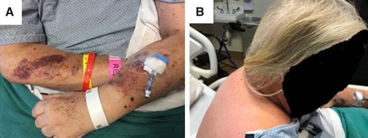 Clinical photograph presenting characteristic physical stigmata of Cushing's syndrome in a patient. Panel A displays a top-down view of the patient's forearm and antecubital fossa, demonstrating significant skin fragility and easy bruisability. Multiple irregular, confluent, purplish-red ecchymotic patches and smaller petechiae are visible across the skin surface. Clinical equipment, including multiple hospital identification bands and an indwelling intravenous catheter with a blue-and-white luer-lock hub, is present on the arm. Panel B illustrates the posterior neck and upper back of the same patient, highlighting a dorsocervical fat pad, commonly known as a 'buffalo hump.' This finding appears as a distinct, rounded, soft-tissue prominence at the level of the cervicothoracic junction, creating an abnormal posterior contour. These visual findings are hallmark cutaneous and musculoskeletal manifestations of hypercortisolism, useful for medical students and clinicians in identifying metabolic or endocrine dysfunction during physical examination.