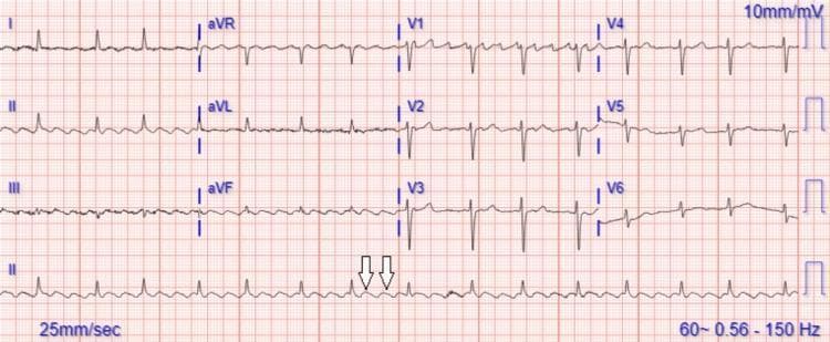 This diagnostic image is a 12-lead electrocardiogram (ECG) recorded at a standard paper speed of 25 mm/sec and calibration of 10 mm/mV. The tracing demonstrates a classic atrial flutter rhythm characterized by a continuous, rapid 'saw-tooth' baseline pattern, most prominent in the inferior leads (II, III, and aVF). White arrows in the long rhythm strip (Lead II) highlight these regular flutter waves. The ventricular rate is irregular due to variable atrioventricular (AV) conduction, where the ratio of atrial impulses to QRS complexes changes periodically. The QRS complexes are relatively narrow with normal morphology, and there is a notable absence of electrical alternans—the QRS amplitude remains stable beat-to-beat, which is an important clinical finding used to rule out significant pericardial effusion causing cardiac tamponade in certain contexts. The ST segments and T waves are largely obscured by the underlying flutter baseline. This ECG serves as an educational example of macro-reentrant supraventricular tachycardia and the identification of variable block patterns.