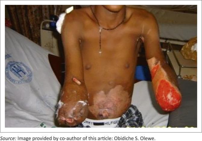 A clinical photograph of a male patient five weeks post-operative, following bilateral upper limb amputations due to high-voltage electrical injuries. The patient has a left above-elbow amputation (transhumeral) and a right below-elbow amputation (transradial). The distal ends of both stumps show active healing; the right stump exhibits significant areas of red granulation tissue and possible skin grafting sites, while the left stump shows signs of tissue repair with some visible exudate or dressing material. The anterior abdominal wall and torso display extensive depigmented and scarred patches, consistent with healed thermal or electrical flame burns covering approximately 10% of the Total Body Surface Area (TBSA). The photograph illustrates the severe musculoskeletal and dermatological consequences of electrical trauma requiring multidisciplinary surgical management, including debridement and escharectomy. This image serves as an educational resource for orthopedic surgery, plastic surgery, and burn rehabilitation units.