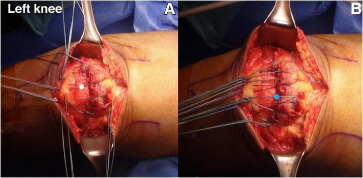 This clinical photograph displays a two-panel intraoperative view (A and B) of a surgical repair for a quadriceps tendon rupture in a left knee. The patient is in a supine position with the surgical site exposed via a midline longitudinal incision. In panel A, the peritendinous quadriceps tendon is being repaired using a figure-of-8 suture technique with No. 1-0 Vicryl sutures, indicated by a white star. The sutures approximate the anterior soft tissue and retinaculum over the superior pole of the patella. Panel B demonstrates the 'suture bridge' technique, where multiple suture limbs originating from the quadriceps tendon are gathered and secured at the inferior pole of the patella, marked by a blue star. This construct ensures the full thickness of the tendon is reattached to the patellar bone, restoring the extensor mechanism. Surgical retractors are visible, providing visualization of the patellar anatomy and the distribution of high-strength suture material across the repair site. The images illustrate key steps in transosseous tendon-to-bone fixation.
