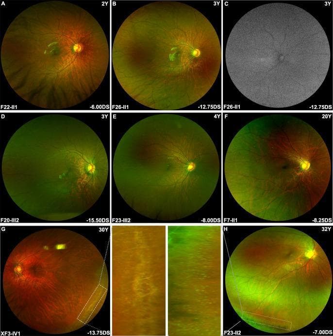 A composite of diagnostic ophthalmological images featuring wide-field fundus photography and fundus autofluorescence (FAF) in patients with early-onset high myopia (eoHM) related to ARR3 variants. Panels A-H display wide-field fundus photographs showing a predominantly tessellated fundus appearance, characterized by increased visibility of the large choroidal vessels due to thinning of the retinal pigment epithelium and choriocapillaris. In younger patients (A-F, ages 2-20Y), the peripheral retina appears relatively preserved. Panel C demonstrates a normal FAF scan with no conspicuous hyper- or hypo-autofluorescence, indicating stable metabolic activity of the retinal pigment epithelium. Panels G and H (ages 30Y and 32Y) include magnified insets of the peripheral retina, highlighting age-related progression marked by lattice degeneration and distinctive white dots. Clinical metadata indicates high myopic refractive errors ranging from -6.00DS to -15.50DS. The collection illustrates the spectrum of myopic maculopathy and peripheral retinal changes associated with X-linked female-limited inheritance in ARR3-related myopia.