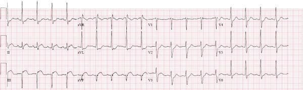 A standard 12-lead electrocardiogram (ECG) demonstrating findings characteristic of an acute inferior wall myocardial infarction (STEMI). The tracing reveals significant pathology in the inferior leads (II, III, and aVF), most notably a 2 mm coved (convex) ST-segment elevation. Lead III and aVF also display prominent pathologic Q waves, indicating evolving myocardial tissue injury or necrosis. Reciprocal ST-segment depression is visible in the high lateral leads (I and aVL), a classic finding in inferior STEMI. The precordial leads (V1-V6) show relatively normal R-wave progression and QRS morphology, though there is subtle ST-segment depression in V2 and V3, which may represent reciprocal changes or posterior extension. This diagnostic image is intended for cardiovascular education, illustrating the key electrocardiographic hallmarks used to identify acute coronary syndromes involving the right coronary artery or left circumflex distributions.