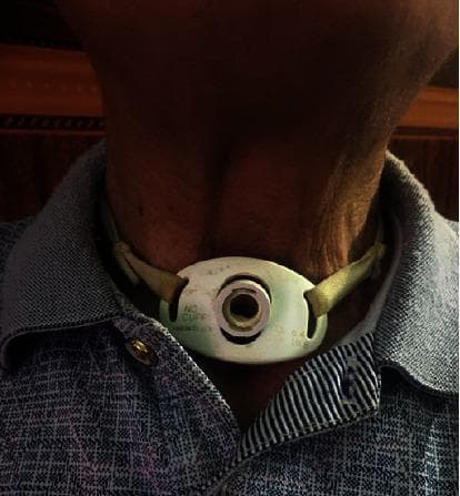 A clinical photograph showing a close-up of a patient's anterior neck with a permanent tracheotomy. A white, oval-shaped tracheostomy tube flange is positioned centrally over the trachea, inferior to the laryngeal prominence. The flange is marked with the text "NO CUFF," indicating a cuffless tube design often used for long-term airway management in patients who do not require mechanical ventilation or have low aspiration risk. The tube is secured to the neck using green cloth tracheostomy ties threaded through lateral slots in the flange. The skin surrounding the stoma appears intact, with no visible signs of inflammation, infection, or stomal breakdown. The patient's neck shows visible skin folds and anatomical landmarks, including the contours of the sternocleidomastoid muscles. This image illustrates post-surgical management following extensive tracheal resection and total thyroidectomy for locally advanced papillary thyroid cancer (PTC).