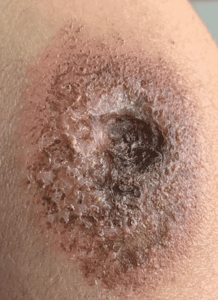 This clinical photograph displays a large, complex skin ulcer characteristic of Pyoderma Gangrenosum. The lesion features a deep central cavity with an irregular, necrotic base containing dark, devitalized tissue. The borders of the ulcer are poorly defined and notably undermined, with a violaceous or dusky hue. Surrounding the primary ulceration is a broad zone of intense erythema and inflammatory induration. The periphery of the lesion shows evidence of crusting, scaling, and small pustular elements, suggesting active progression. The overall appearance is consistent with an aggressive, inflammatory neutrophilic dermatosis, emphasizing the classic 'undermined' edge and necrotic floor used for clinical diagnosis in dermatology.