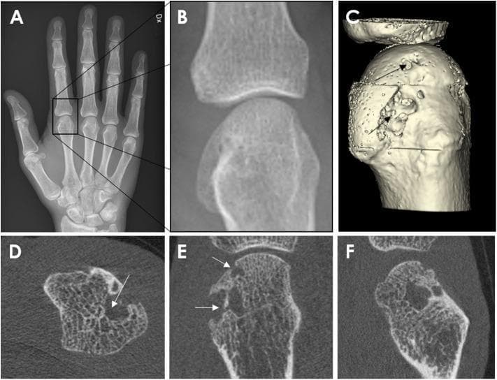 This composite diagnostic image demonstrates the utility of different imaging modalities in identifying bone erosions in a 62-year-old male with rheumatoid arthritis. Panel A is an anterior-posterior (AP) radiograph of the right hand, with a magnified view (B) focusing on the second metacarpophalangeal (MCP) joint. Panels C-F utilize High-Resolution Peripheral Quantitative Computed Tomography (HR-pQCT). Panel C shows a 3D surface reconstruction of the metacarpal head, where arrows highlight deep, pitted cortical erosions and irregular surface morphology. Panels D (axial), E (coronal), and F (sagittal) provide cross-sectional HR-pQCT views, revealing significant discontinuity in the cortical shell and the subsequent loss of underlying trabecular bone structure. These images illustrate the superior sensitivity of HR-pQCT over conventional radiography in detecting and quantifying juxta-articular erosions, which appear as non-linear breaks in the cortical bone in multiple perpendicular planes. The visual data emphasizes the pathological bone remodeling and microstructural degradation characteristic of advanced inflammatory arthritis.