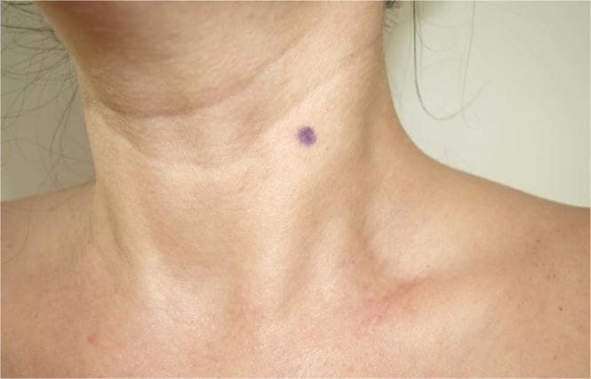 This clinical photograph displays the surface anatomy of the human neck and upper shoulder region in an anterior-lateral view. The primary anatomical landmark visible is the sternocleidomastoid (SCM) muscle, whose contour is clearly delineated as it courses from the mastoid process toward the sternum and clavicle. A circular, purplish skin marking is present on the mid-substance of the SCM muscle belly. This mark identifies the standardized measurement site for assessing myofascial tissue properties, specifically located midway between the muscle's insertion at the manubrium sterni and its origin at the mastoid process, where the sternal and clavicular heads converge. Other visible landmarks include the clavicle, the suprasternal notch, and the lateral cervical triangle. This image serves as a reference for clinical assessments of muscle stiffness and elasticity using devices such as the MyotonPro, demonstrating the appropriate anatomical positioning for perpendicular probe placement in physical therapy and musculoskeletal research.