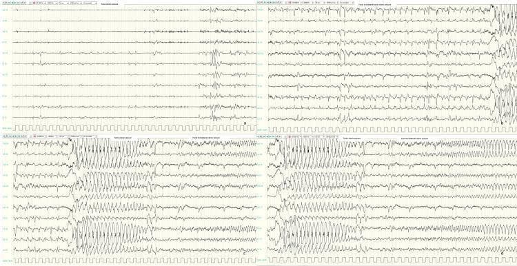 This diagnostic image displays four panels (a–d) of neonatal ictal electroencephalogram (EEG) recordings demonstrating the progression of seizure activity. Panel (a) shows the initial ictal state with focal repetitive sharp waves localized to the left central region, clinically correlating with a focal clonic seizure. Panel (b) illustrates the evolution toward focal to bilateral involvement, characterized by repetitive sharp waves emerging in the centro-temporal regions, notably on the right hemisphere. Panels (c) and (d) represent the secondary generalization of the seizure, featuring high-amplitude, rhythmic spike-and-slow-wave discharges across all channels. The waveforms exhibit a distinct temporal evolution in frequency and morphology, transitioning from discrete focal sharp waves to a continuous, generalized discharge pattern typical of a focal to bilateral tonic-clonic seizure. These EEG findings are significant in the context of intractable neonatal epilepsy and are used for localizing seizure onset and monitoring the efficacy of antiepileptic therapy.
